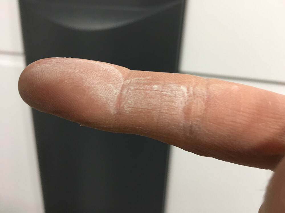 Nahaufnahme eines Fingers mit trockener Haut und leichten Rissen